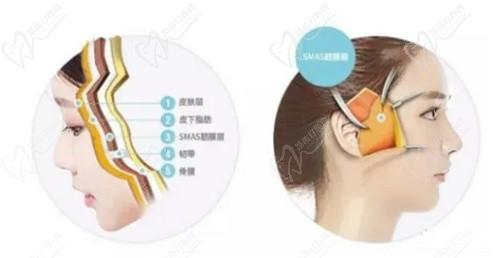 南京米兰柏羽裴旭芳拉皮除皱如何?SMAS筋膜层3D立体面部提升受好评