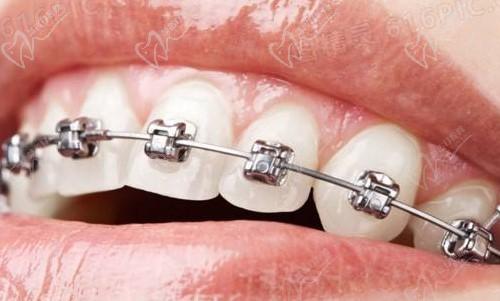 兰州海涛口腔医院牙齿矫正怎么样？正畸价格全程透明,数字化3D技术更精细