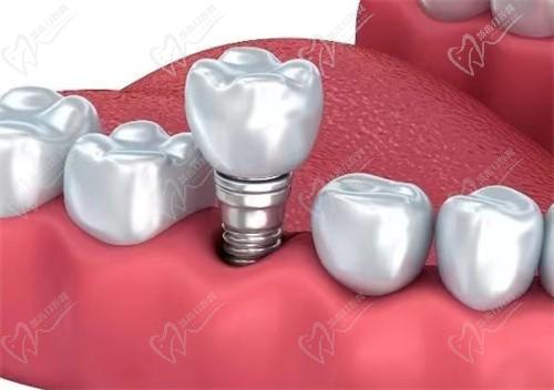 宁波艺星口腔医院价格表公开，瑞士ITI种植体3800元起，预约咨询享优惠！