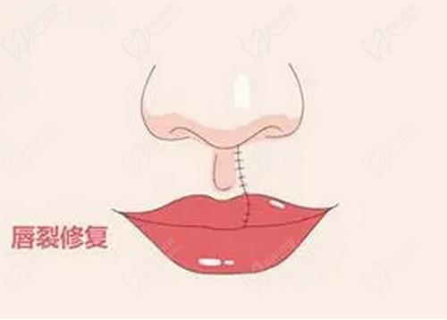 武汉做唇腭裂修复鼻子好的医院是武汉同济，叶子荣唇腭裂、隆鼻技术好