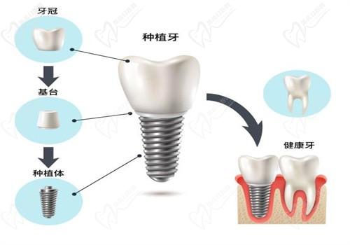 广州曙光口腔医院种牙价格表:单颗1980|半口16800|全口26800起