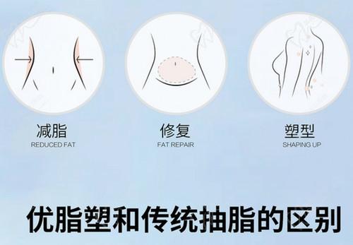 武汉同济医院整形外科吸脂技术不错，做优脂塑全身抽脂获理想身材曲线