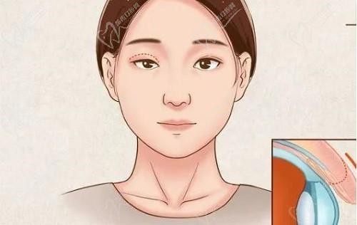 魏志香高难度眼睛修复怎么样?魏志香双眼皮修复实例多口碑好绝不是营销医生