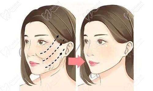 深圳博爱曙光整形医院做小拉皮3w+,陈志茹技术好改善松弛下垂