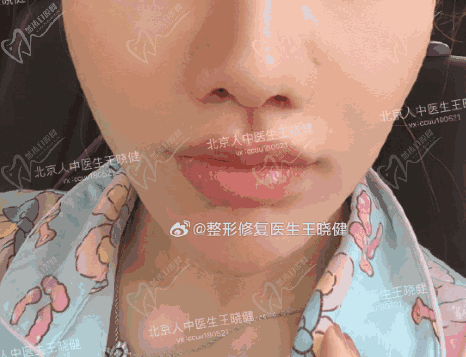 王晓健人中缩短术怎么收费？北京王晓健人中缩短价格1.98w+|人中加深1.38w+