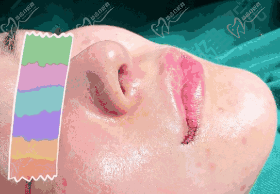 王晓健人中做得好吗？王晓健人中缩短嘴角上扬案例效果惊艳附价格可预约