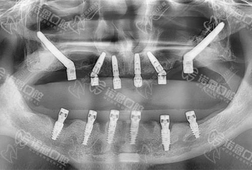 徐州诺恩口腔种植牙怎么样？专科团队/高端设备/合理收费助力腔健康