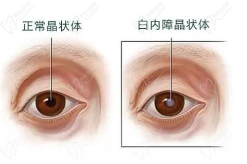 西安医大眼科医院白内障手术靠谱,多焦点人工晶体15600+,王从毅医生亲诊