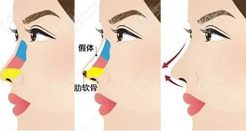刘彦军做鼻子多少钱起步啊？做初鼻价格50000+,鼻修复80000元起