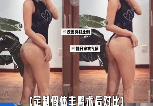 深圳福雅胡俊杰做假体丰臀怎么样？定制假体欧式丰臀三件套超脂塑腰腹环吸丰胯好惊艳