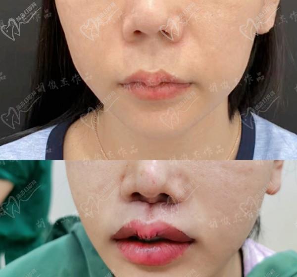 胡俊杰人中缩短三件套，测评是免拆线缩短人中和嘴角上扬等技术腻害口碑颇高！