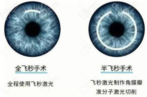 西安佰视佳眼科近视手术价格表2025:飞秒7000+|ICL晶体植入术26600+