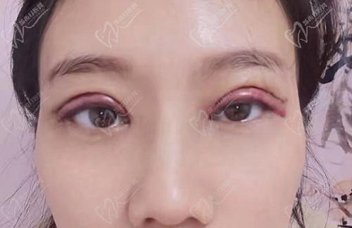 林靖医生修复双眼皮没有失败的可能！看成都纯曦林靖眼修复实例大成功