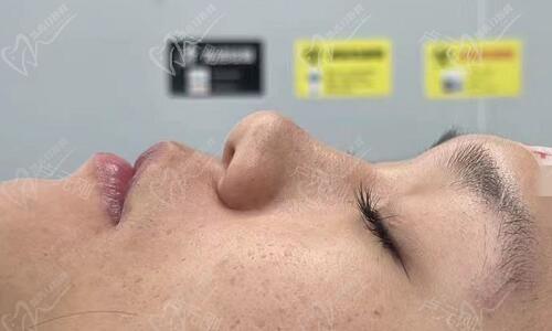 成都卢元刚做的鼻子怎么样?看对比实例卢元刚医生鼻子做的挺好看