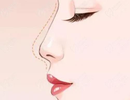 刘彦军做鼻子为什么这么贵？看过刘彦军的个人资料简介和隆鼻实例真不觉贵