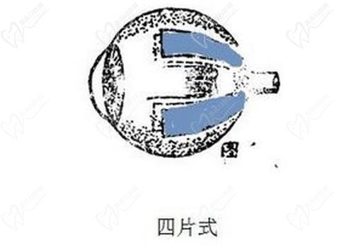 武汉华厦眼科医院戴鸿斌医生：做后巩膜加固术能控制住高度近视增长