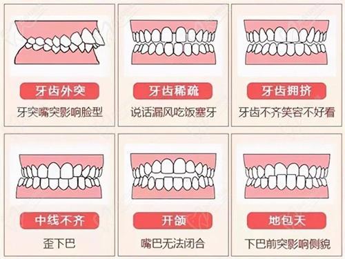北京张栋梁医生正畸实例图片-偏颌/牙不齐/后缩/凸嘴/地包天等牙齿矫正实例汇总