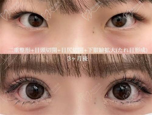 西安董潇双眼皮怎么样？西安董潇双眼皮哪个医院？西安董潇预约挂号方式