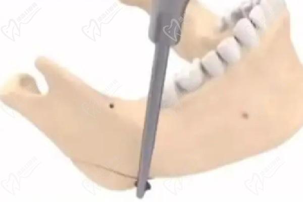 郭军磨骨在上海哪个医院-在仁爱医院飞刀蘑骨实例多多贵且值