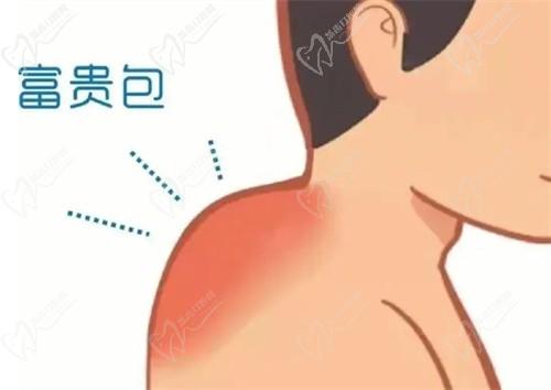 李方伟富贵包收费明细:李方伟富贵包抽脂9800+富贵包切除15800+可在线联系预约