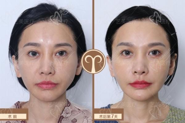 北京艺美整形王东修复脂肪好不好？脂肪修复有名气，面吸不戴头套&体雕无渗液可见技术优势
