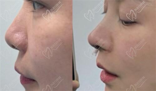 北京靳玉彪在哪家医院?靳玉彪做的鼻子怎么样?北京靳玉彪鼻综合案例：