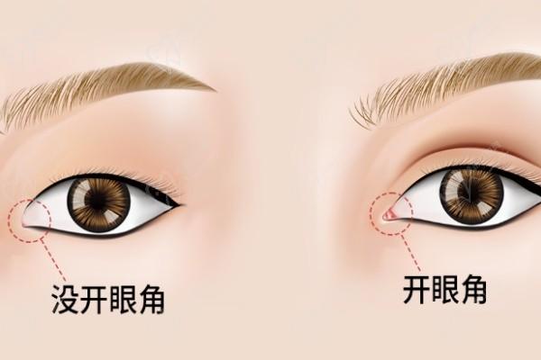 北京蒂凡妮郭建玲双眼皮修复技术怎么样？缝合细致擅长多种个性修复病例反馈好