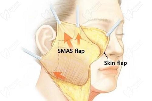 北京杨俊和黄寅守拉皮手术和审美那个更好?解析黄寅守和杨俊拉皮谁更厉害
