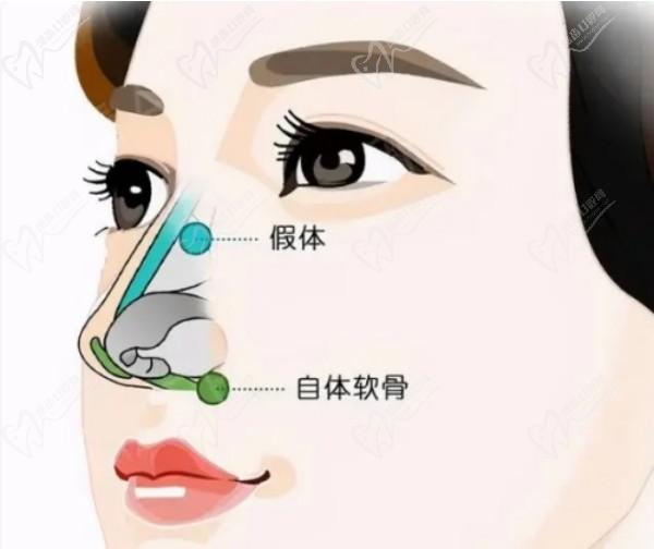 武汉吴辉医生做鼻子怎么样？个人公开资料显示鼻综合及鼻修复技术都挺牛