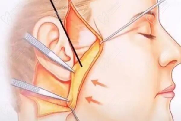 北京华韩谢立宁做大拉皮吗？口碑非常好，点击简介了解他的技术、费用和医院优势。