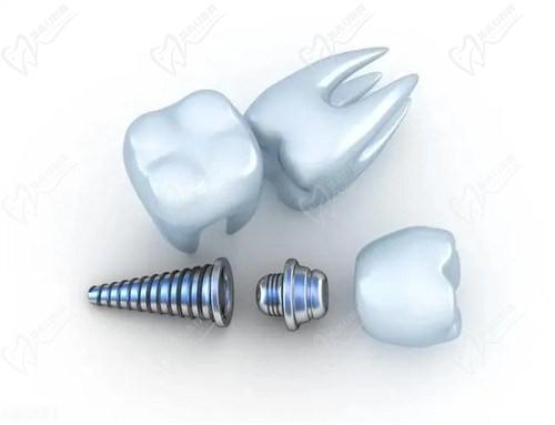 南宁诺贝尔口腔医院价格表-2025版：种植牙/牙齿矫正/补牙...等费用