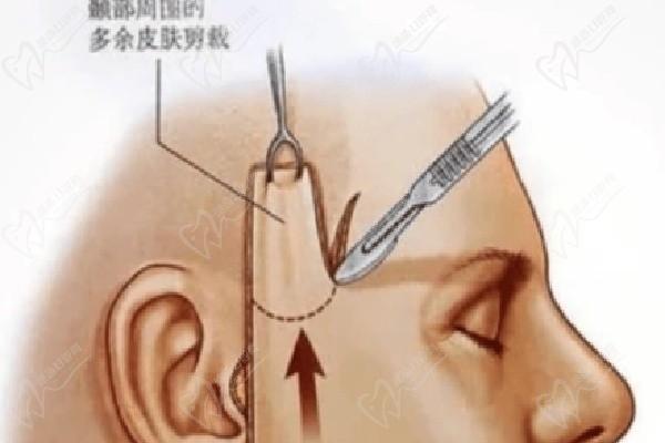 北京杨大平的面部提升切口位置在耳后吗？在耳后隐痕，看我2cm缝合杨大平小切口提升花了4W的体验
