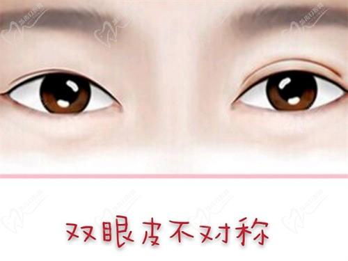 车红昌在哪家医院?现在成都新华医院坐诊双眼皮修复在成都的口碑评价挺好的