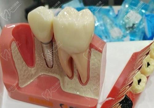 南京美奥口腔种植牙价格3-9k元，有登腾/皓圣/贝格/诺贝尔等植体