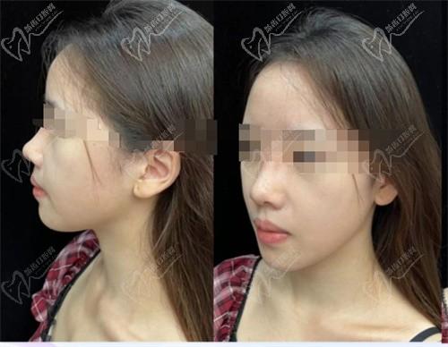 杨水斌做的鼻子有人出来说一下吗？亲历者反馈一刀改善“塌鼻短鼻+嘴凸”太可了！