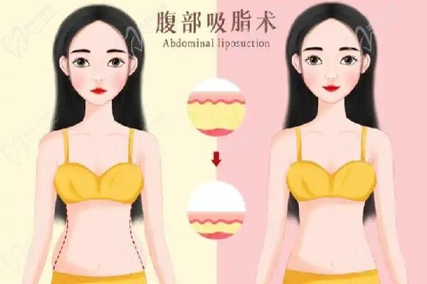 北京郑京桓医生做吸脂在哪家医院-在北京煤医微信可预约挂号看医生简介