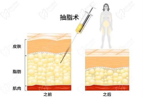 宋新医生现在在哪个医院坐诊？2025找宋新吸脂去广州美莱整形，地址在天河区可在线预约