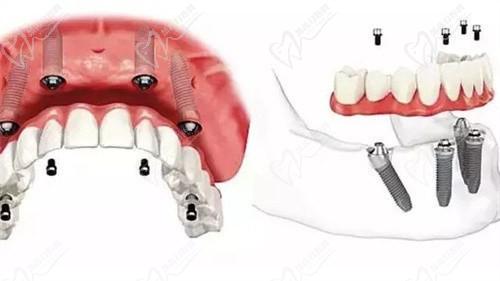 南京博韵口腔医院种植牙价格表2025：公布单颗/半全口种植牙收费标准