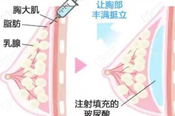 北京英煌间联祖细胞丰胸怎么样？适合大尺度丰胸无异物感,脂肪丰胸排名前十的项力源医生可手术